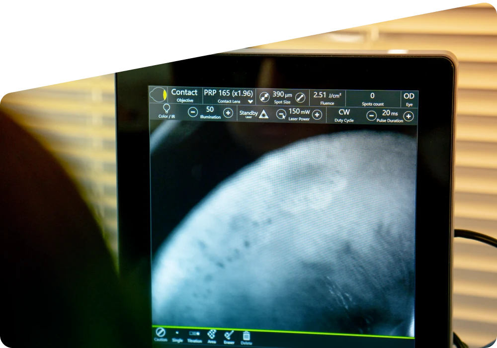 Retinal Detachment: Symptoms, Causes, Types, and Treatment