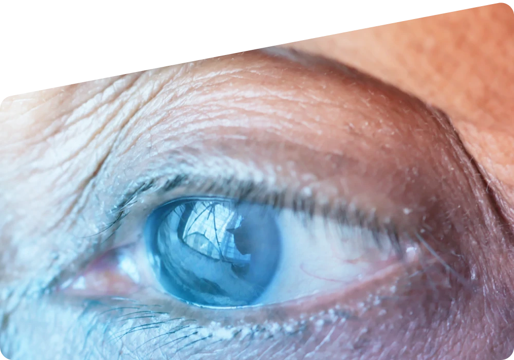 What Is Glaucoma? Meaning, Causes, Symptoms, and Treatment Options