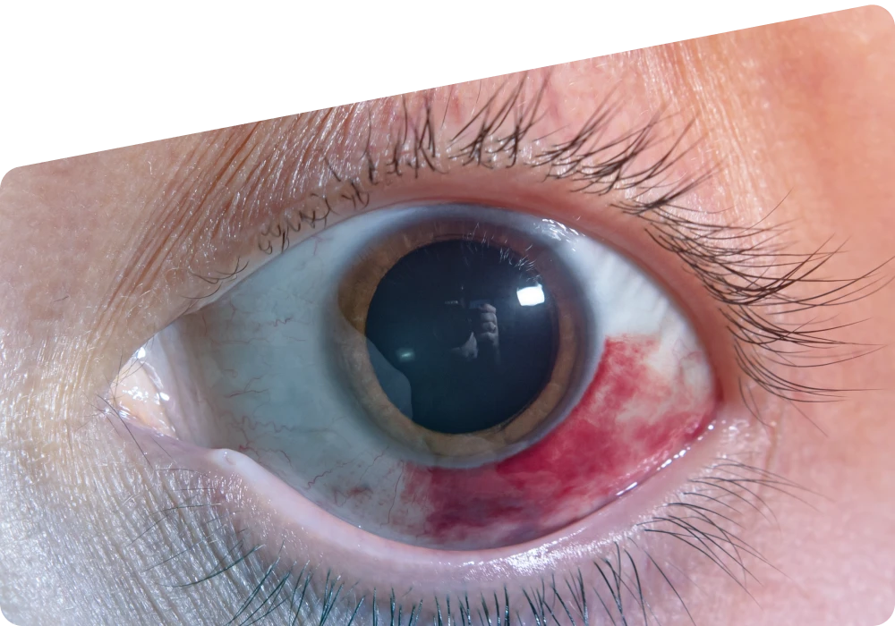 Scratched Cornea: Symptoms, Causes, Treatment, and When to See a Doctor