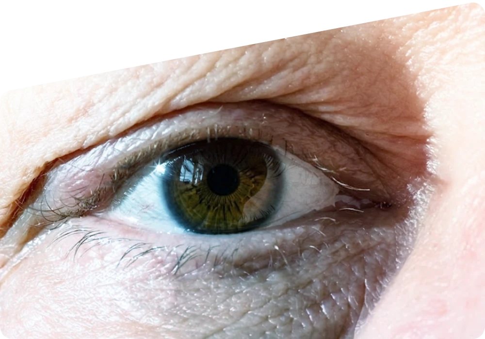 What Is Drooping Eyelid? A Clear Guide to Ptosis, Causes, and Treatment