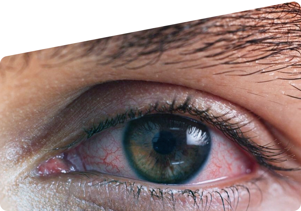 Blocked Tear Duct: Causes, Symptoms, Treatment, and When Surgery Is Needed